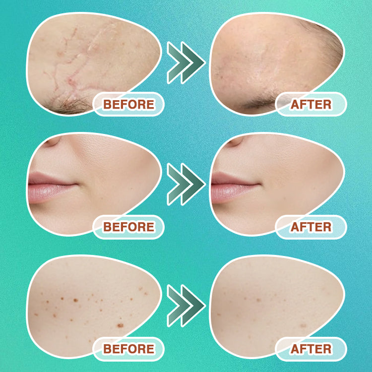 𝘾𝙖𝙧𝙚𝘽𝙧𝙚𝙚𝙯𝙚® Microneedle Scar Removal Patch