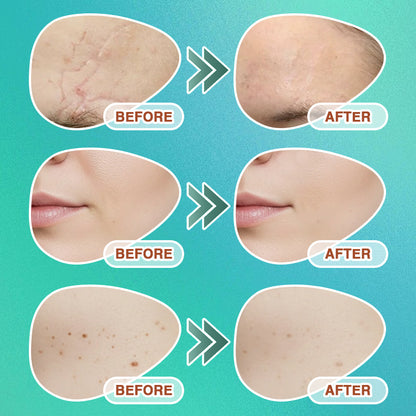 𝘾𝙖𝙧𝙚𝘽𝙧𝙚𝙚𝙯𝙚® Microneedle Scar Removal Patch
