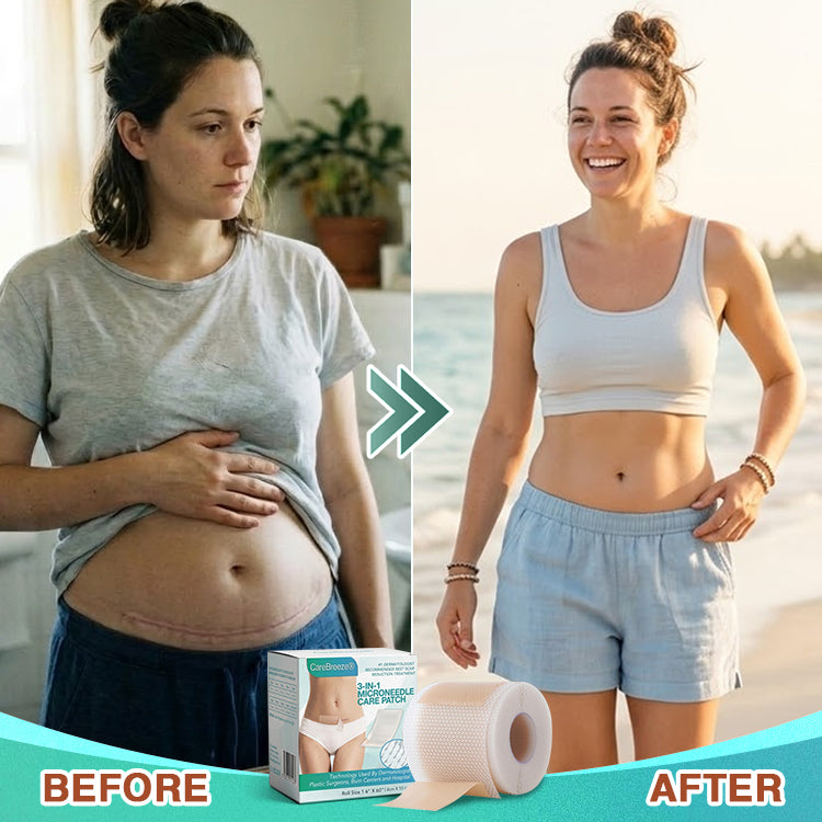 𝘾𝙖𝙧𝙚𝘽𝙧𝙚𝙚𝙯𝙚® Microneedle Scar Removal Patch